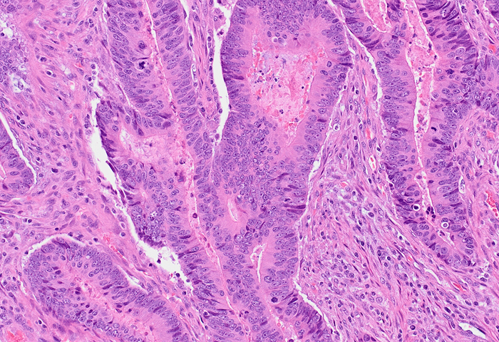 This typical colon adenocarcinoma demonstrates irregular, malignant glands set in desmoplastic stroma.