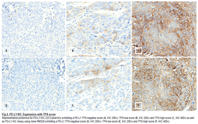 Comparative Analysis of a New IHC Assay for PD-L1 Expression in Non-Small Cell L…