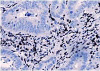 Microscopic image of tissue stained with hematoxylin and eosin, showing clusters of dark-stained cells among lighter tissue structures.