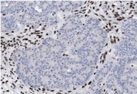 Microscopic image of tissue with clusters of brown-stained nuclei among mostly blue-stained cells, indicating positive immunohistochemical staining.