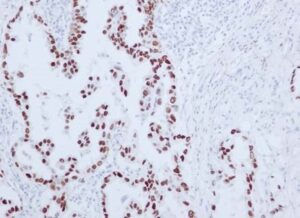 Thyroid Transcription Factor-1 (TTF-1)