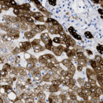 Microscopic view of stained tissue cells showing brown and blue coloration, with irregular cell shapes and clustered nuclei.