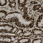 Microscopic image showing densely packed, dark-stained cell nuclei arranged in glandular structures, typical of tissue viewed under high magnification.