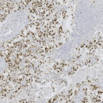 Microscopic view of tissue sample showing numerous dark-stained nuclei scattered throughout a lighter background, consistent with immunohistochemical staining.