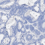Microscopic view of tissue section stained with hematoxylin, showing clustered and scattered cell nuclei in various gland-like structures.