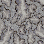 Microscopic view of tissue sample showing branched, irregular structures outlined by dark staining, surrounded by lighter areas with scattered cells.