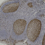 Microscopic view of lymph node tissue showing three brown-stained germinal centers surrounded by lighter-stained areas, indicating differential cell presence.