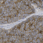 Microscopic image showing densely packed brown-stained cells with a lighter, irregular band running diagonally across the center.