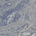Microscopic image of tissue showing densely packed blue-stained cell nuclei and scattered brown-stained cells among fibrous structures.