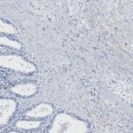 Microscopic image of tissue showing glandular structures on the left and dense connective tissue with scattered cells on the right, stained for histological examination.