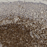 Microscopic image of tissue showing densely packed dark brown stained cells in the lower region and lighter stained cells in the upper region.