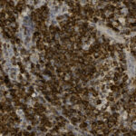 Microscopic image showing densely packed brown-stained cells, likely from a tissue sample prepared with immunohistochemical staining.