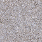 Microscopic view of cells stained with a brown dye, scattered densely across a light background, commonly seen in immunohistochemistry slides.