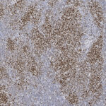Microscopic view of tissue stained with brown and blue hues, showing dense cellular structures and varying texture patterns across the sample.
