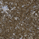 Microscopic image of densely packed brown-stained cells, likely from a tissue sample, with varying shades and some lighter areas interspersed throughout.