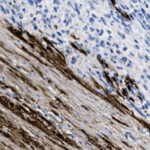 Microscopic image showing stained tissue, with dense brown-stained regions and lighter areas containing numerous blue cell nuclei.
