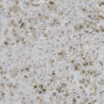 Microscopic view of stained liver tissue showing hepatocytes with brown areas indicating positive staining and blue nuclei throughout the sample.