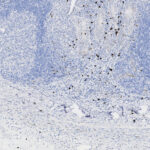 Microscopic view of tissue stained with hematoxylin and eosin, showing varying cell densities and structures in blue and purple hues.