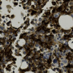 Microscopic image showing densely clustered cells with brown and blue staining, some clear circular spaces, and irregular granular texture.
