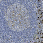 Microscopic view of tissue sample showing densely packed cells stained blue, with a lighter central area and darker brown-stained regions on the right side.