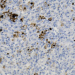 Histological slide showing numerous small, blue-stained cells with scattered dark brown-stained areas throughout the tissue sample.
