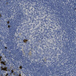 Microscopic image showing densely packed cells stained in varying shades of blue and some brown areas, likely representing a tissue sample.