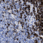 Microscopic image showing densely packed blue-stained cells with clusters of dark brown-stained cells, indicating differential cellular or protein expression.