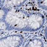 Microscopic image of tissue stained with blue and brown dyes, showing cell nuclei and darker spots scattered throughout the sample.