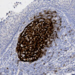 Microscopic image showing a dense, dark-stained cluster of cells surrounded by lighter-stained tissue, likely representing a lymphoid follicle or similar structure.
