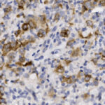 Microscopic view of tissue stained with brown and blue dyes, showing clusters of cells with varying coloration.