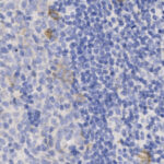 Microscopic image of densely packed blue-stained cells, likely representing lymphocytes in tissue, with occasional brown-stained areas.