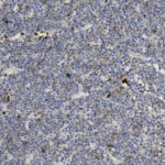 Microscopic view of tissue section showing densely packed blue-stained cells with scattered brown-stained spots, likely highlighting specific cell components or markers.