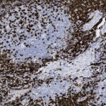 Microscopic image showing a tissue sample with densely packed dark-stained cells and lighter areas, typical of immunohistochemistry staining.