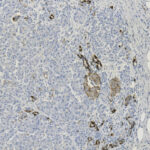 Microscopic image showing tissue with clusters of brown-stained cells among predominantly blue-stained cells and a section of white, bubble-like spaces on the right.