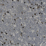 Microscopic view of a tissue sample stained with brown and blue markers, showing scattered dark-stained cells among lighter-stained background cells.