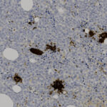 Microscopic image showing clusters of dark brown stained cells among numerous light purple cells, with several large white circular spaces.