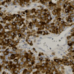 Microscopic image showing densely packed brown-stained cells with irregular shaped lighter areas and small, round blue nuclei distributed throughout.