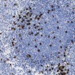 Microscopic image showing clusters of dark brown-stained cells scattered among numerous smaller blue-stained cells, suggesting immunohistochemical staining of tissue.