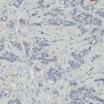 Microscopic image showing clusters of dark-stained cell nuclei surrounded by fibrous, light-stained connective tissue.
