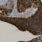 Microscopic image of tissue with brown-stained areas indicating positive immunohistochemical staining, and blue-stained areas representing cell nuclei.