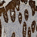 Microscopic image of tissue stained to show cell nuclei in blue and cell membranes or structures in brown, displaying glandular patterns.
