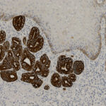 Microscopic image showing tissue with dark brown stained areas indicating positive immunohistochemical labeling, surrounded by lighter unstained or weakly stained cells.