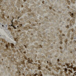 Microscopic view of tissue stained with brown dye, showing numerous clustered cells with dark nuclei and varying intensity of coloration throughout the sample.