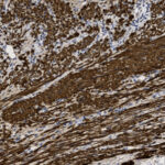 Microscopic image of tissue showing dense brown staining in clustered and streaked patterns with scattered blue cell nuclei, likely indicating an immunohistochemical stain.