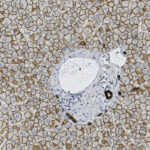 Microscopic image of liver tissue showing a large pale cell with several dark spots surrounded by many smaller, densely packed cells.