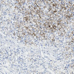 Microscopic image showing tissue sample with densely packed, stained cells in the upper area and fewer, lighter-stained cells in the lower area.
