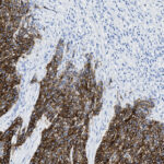 Histological image showing brown-stained cells concentrated in certain areas, while other regions contain mostly unstained or faintly stained cells with visible nuclei.