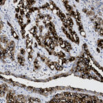 Microscopic image of stained tissue sample showing clusters of cells with dark brown and light blue coloration, likely from immunohistochemistry analysis.