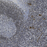 Microscopic image of tissue sample showing densely packed cells, with varying shades of brown and blue indicating possible staining for histological analysis.