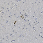 Microscopic view of tissue with numerous small, round, blue-purple stained cells and several brown-stained structures scattered throughout the field.
